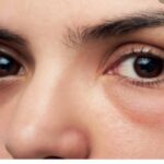आँखों की एलर्जी के लिए सर्वोत्तम होम्योपैथिक दवाएं
